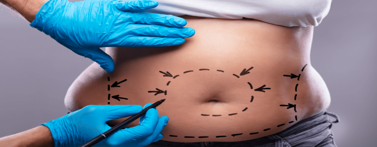 Liposuction/Fat Removal Treatment